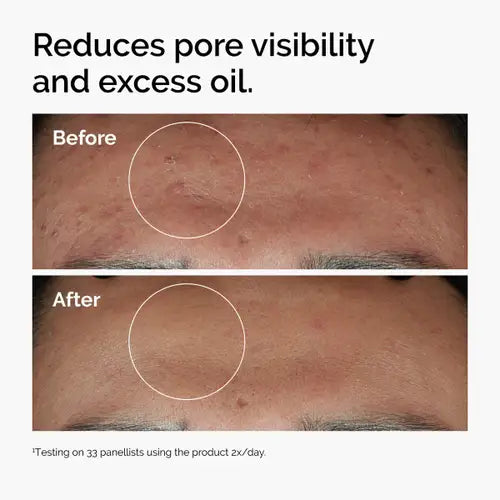 The Ordinary's Niacinamide 10% + Zinc 1% Serum