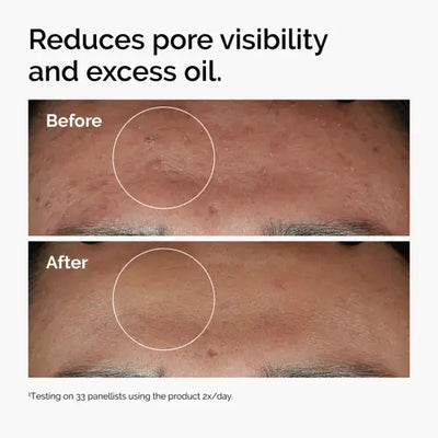 The Ordinary's Niacinamide 10% + Zinc 1% Serum